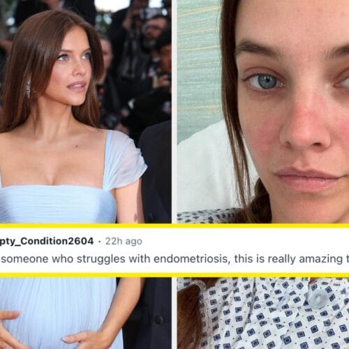 "Why Barbara Palvin's Baby Bump Has Endometriosis Warriors Laughing and Crying—The Surprising Connection You Didn't Expect!"